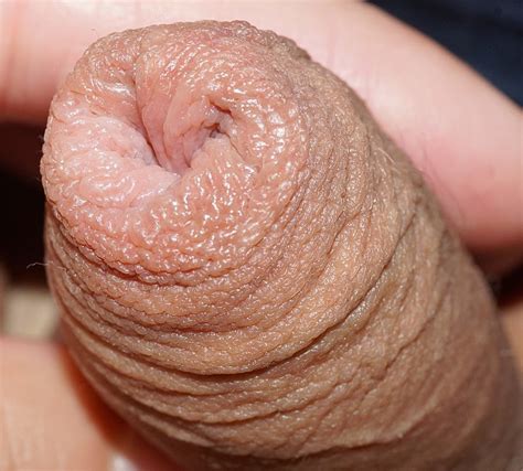 File A Close Up Of Human Foreskin Wikimedia Commons