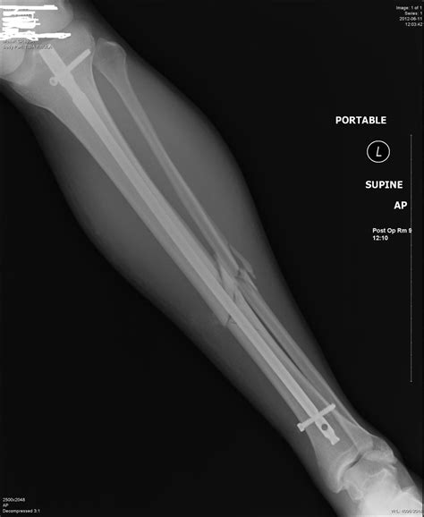 Fractured Tibia And Fibula Broken Lower Leg Bones With Fixation