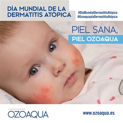 D A Mundial De La Dermatitis At Pica De Noviembre