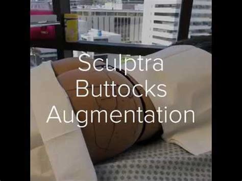Sculptra Non Surgical Buttocks Augmentation Youtube