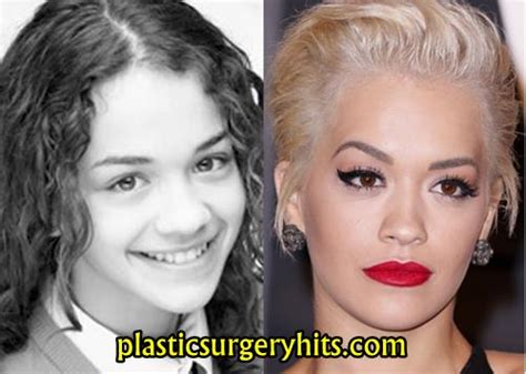 Rita Ora Plastic Surgery Before And After