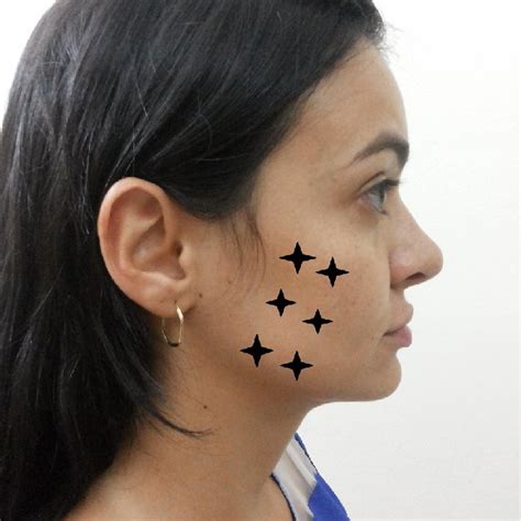 Extraoral Low Level Laser Therapy Application Points Along The Masseter Download Scientific