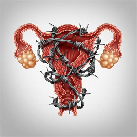 Operation Er Effektiv Behandling For Endometriose