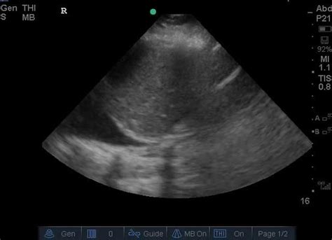 Pleural Effusion On Ultrasound