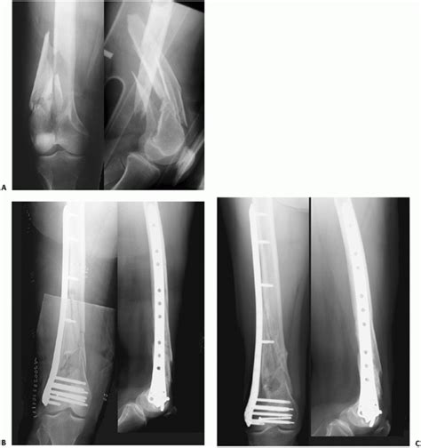 Distal Femur Fractures Teachme Orthopedics