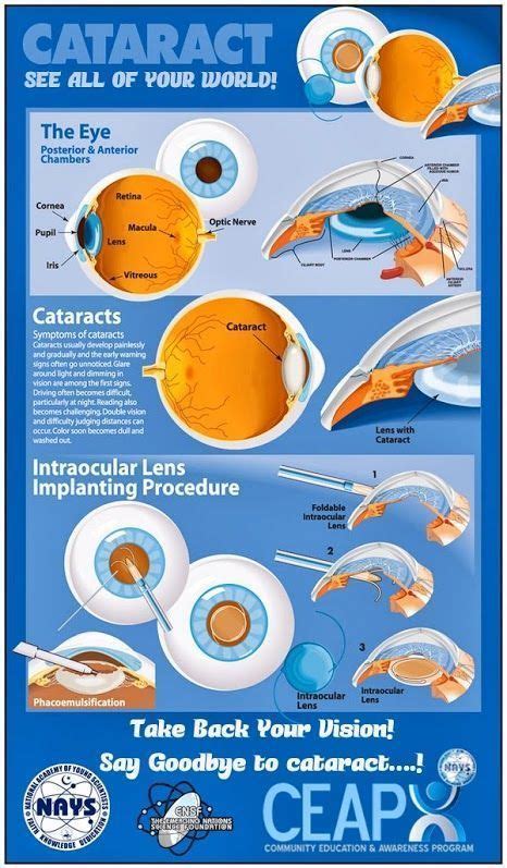 Cataract Infographic For Cataract Awareness Month Eye Facts Cataract