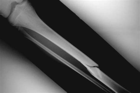 We did not find results for: Fractura de Tibia ¿Cuánto tiempo tarda en sanar? - Dr ...