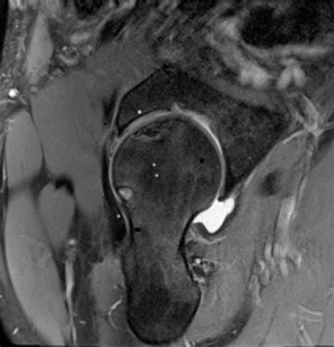 On This T2 Weighted Axial Magnetic Resonance Imaging Cut An