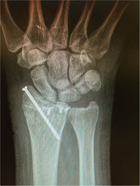A Radiocarpal Fracture Dislocation Treated With Screw Fixation Of The