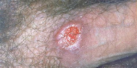 5 Types Of Ulcers Causes Symptoms And Treatment Kenyan Moves