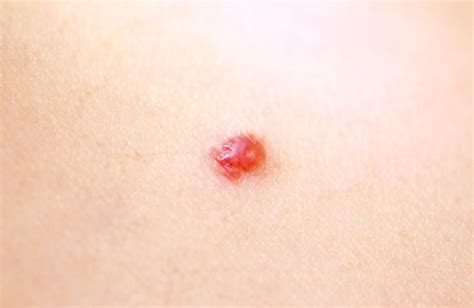 Cherry Angioma Removal Safe And Effective Treatment For Skin Lesions