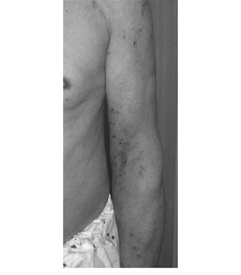 The Patient Had Multiple Erythematous Crusted Plaques On The Left Arm