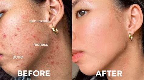 Easy Way To Get Rid Of Acne Tiny Bumps Redness Texture Acne Scars