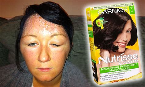 Mother Hospitalised For Three Days After Allergic Reaction To Hair Dye Almost Killed Her Daily