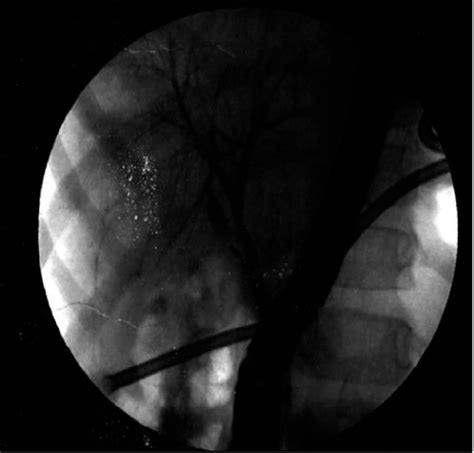 Endoscopic Retrograde Cholangio Pancreatography Showing Small Leak From