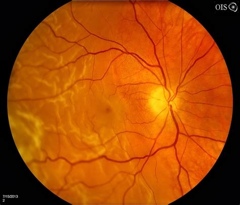 Retinal Detachment With Macula Detached Retina Image Bank