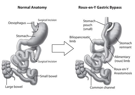 Gastric Bypass Gastric Bypass The Journey What Is The Gastric Route Y