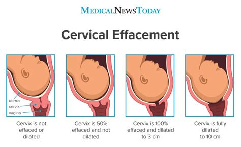 dilated cervix diagram