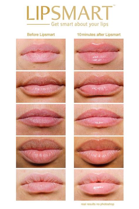 Before And After Lipsmart Botox Lips Anti Aging Lips Lip Fillers