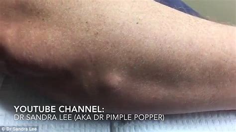 Yellow Fatty Lump Bursts Out Of A Mans Arm As A Doctor Cuts Into It