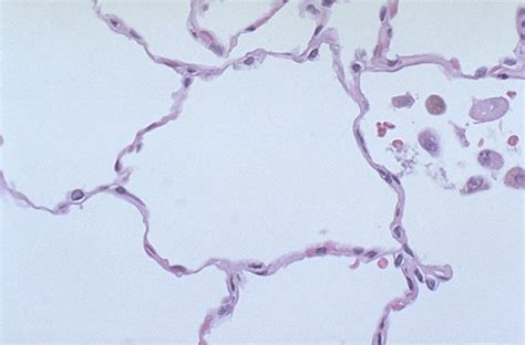 Alveolar Macrophage Histology