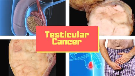 Testicular Cancer Symptoms Causes Pictures Signs And Symptoms Of