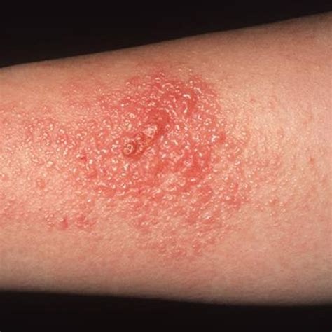 Skin Rash With Blisters