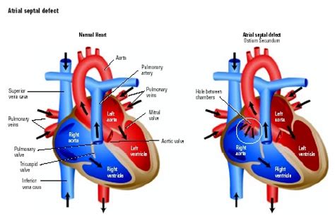 Pemasangan Aso Ado Avo Heartology