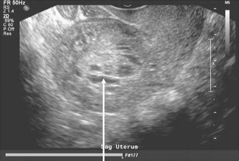 Persistent Secondary Postpartum Hemorrhage After Uterine Artery Hot