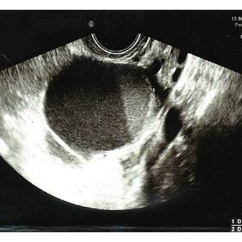 Pelvic Ultrasound Ovarian Cancer