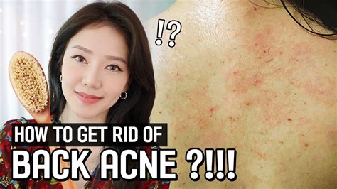 How To Get Rid Of Back Acne Shower Routing For Back Acne Feat