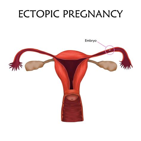 Beths Story Of Ectopic Pregnancy Shows Why We Should Know All Signs