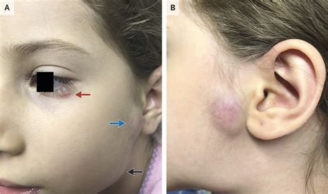 Parinauds Oculoglandular Syndrome In Cat Scratch Disease Nejm