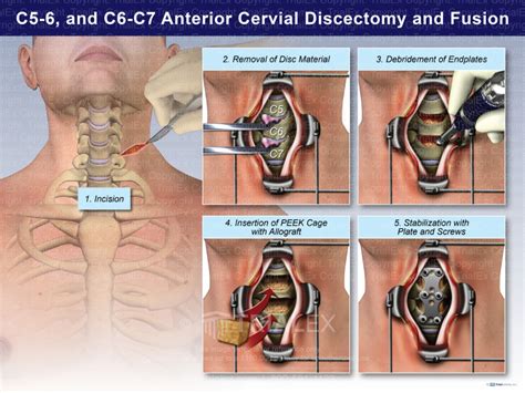 C5 6 And C6 7 Anterior Cervical Discectomy And Fusion Trialexhibits Inc