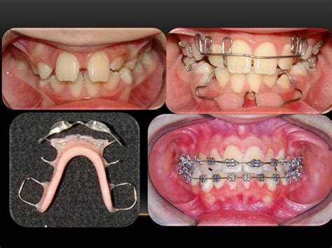 Removable Orthodontic Appliances Orthodontist Youtube