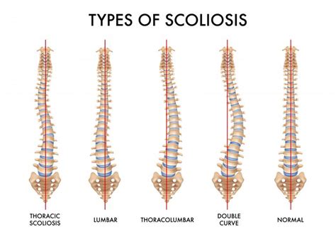 Scoliosis Symptoms Types And Causes Island Orthopaedics