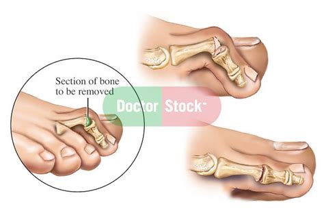 A hammer toe or contracted toe is a deformity of the proximal interphalangeal joint of the second, third, or fourth toe causing it to be permanently bent. Hammer toe | Everything Orthopaedic | Pinterest