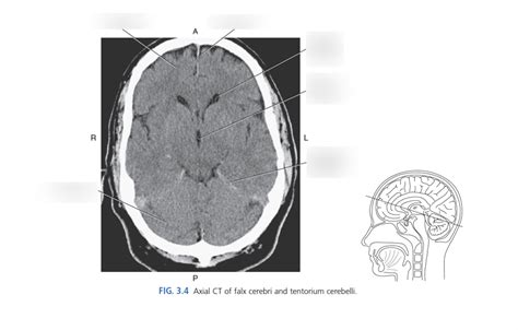 Axial Ct Of Falx Cerebri And Tentorium Cerebelli Diagram Quizlet