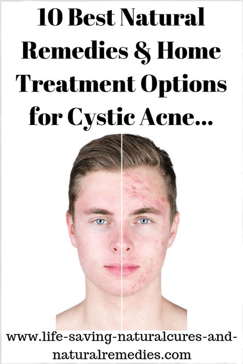 Natural Remedies For Cystic Acne Exciting Breakthrough
