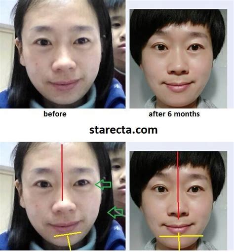 In addition to braces, the orthodontist will develop a plan that can help smooth out the jawline. How to develop, widen and make your face more symmetrical