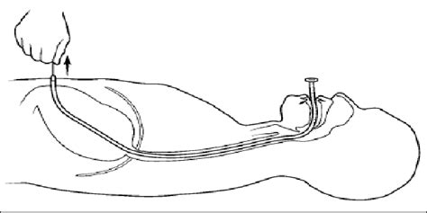 Pull Percutaneous Endoscopic Gastrostomy Tube Technique At The