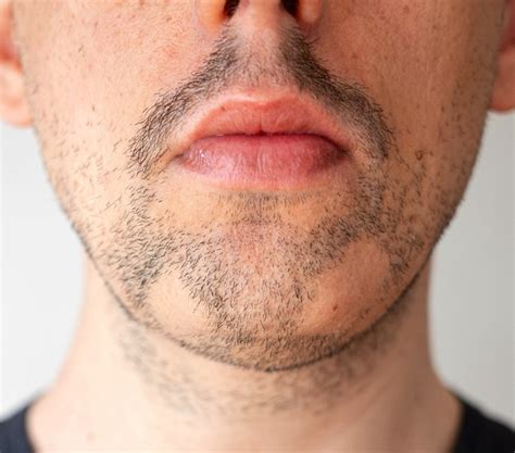 Bald Spot In Beard Under Chin 6 Easy Fixes