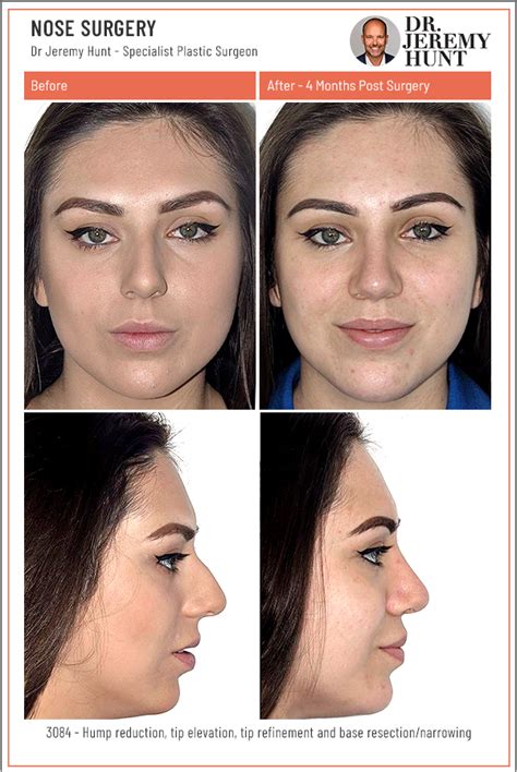 Alarplasty Nostril Reduction Sydney Dr Jeremy Hunt Plastic Surgeon