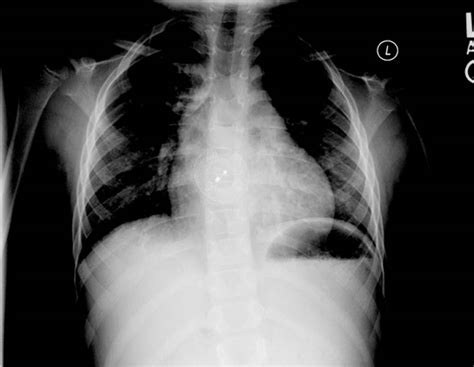 Atrial Septal Defect Chest X Ray Wikidoc