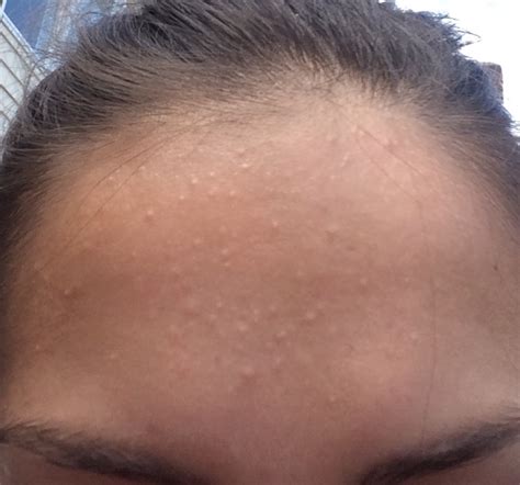 Small Red Bump On Forehead Pictures Photos
