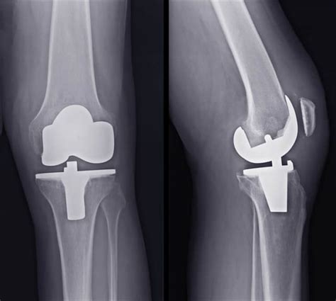 Knee Replacement Surgery What To Expect Before And After Surgery 2023