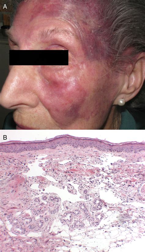A Erythematous Violaceous Plaque With Welldefined Borders In The