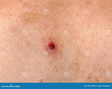 Torn Off A Bleeding Pimple On The Skin Inflammation Acne Stock Image