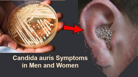 Candida Auris Symptoms In Men And Women Should Never Be Ignored