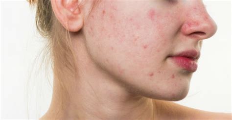 Common Causes Of Facial Redness The Dermatology Office